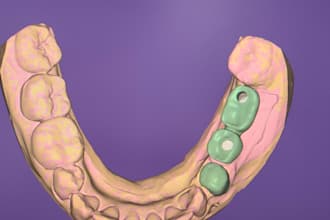 design crown bridge implant design and surgical guides