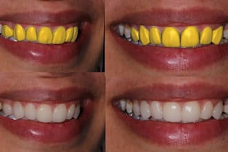 exocad design esthetic veneers, crowns, implants