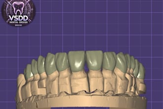 design crowns, bridges, veneers and full arch restorations using exocad