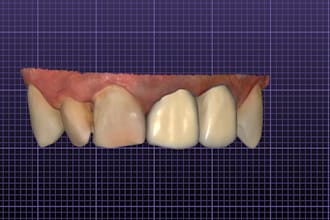 design high quality dental restorations in exocad, first crown free