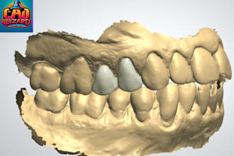 3shape design for crowns, implants, bridges, inlaysonlays, etc