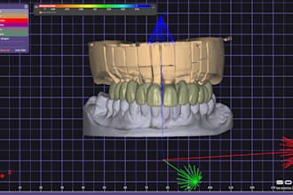 design crowns, bridges, and implants using exocad