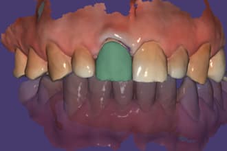 design crowns and bridges on exocad software