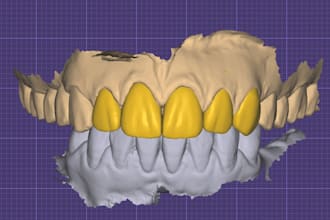 do exocad framework crown bridge all on x smile designe