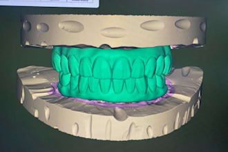 design all on x implants  using exocad 1 hour delivery