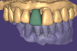 design dental crowns, bridges, and veneers in exocad