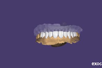 create dental restorations using exocad