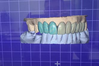 design dental crowns, bridges, and full dentures using exocad