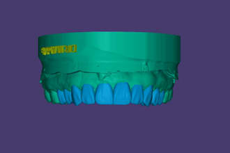 design high quality dental restorations using exocad