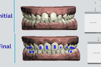dental clear aligner treatment plan on 3shape and onyxceph
