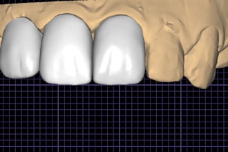 design precise dental restorations using cad cam