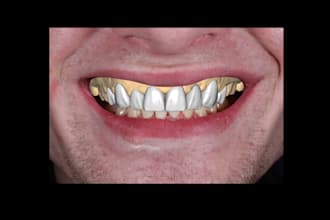 design dental waxup dsd using exocad