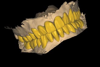 design crown bridge and dental restorations in exocad