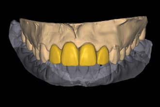 design in exocad functional and aesthetic crown bridges