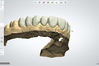 design crown bridge and dental restorations in exocad