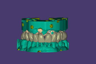 exocad implant dental design