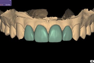 create esthetic veneer designs and dsd in exocad