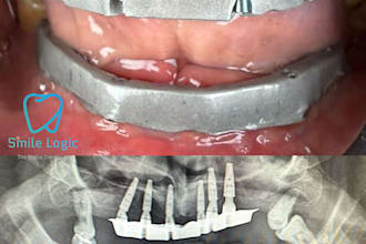 design ibars and gingivectomy guides using b4d and exocad