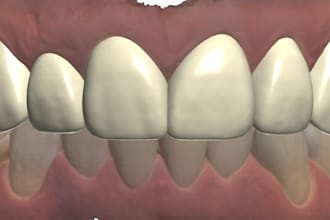 design highly precise perfect dental fixed prothesis using  3shape