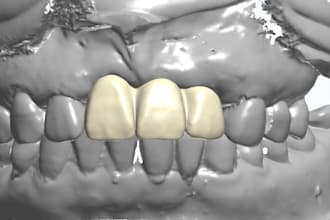 design precise 3shape dental implant crown and bridge cad