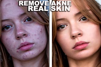 remove acne and retouch skin naturally
