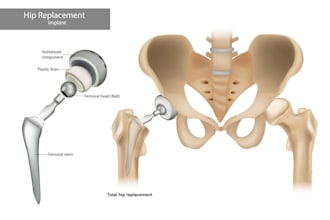 create precise prosthetic and implant 3d designs for medical and biomedical