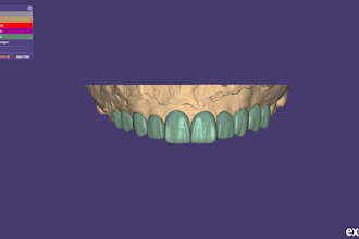 design crowns, bridges, using exocad