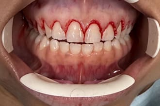 design precise gingivectomy guide
