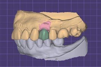 design crown and bridges in exocad