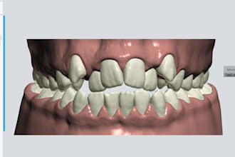 custom aligner treatment plans with 3d clincheck