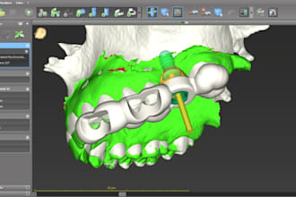 design prosthetically guided dental implant surgical guides