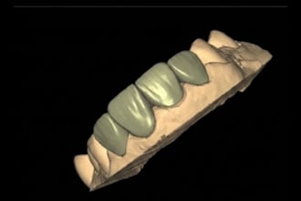 design crowns, full mouth rehabs and veneers in exocad