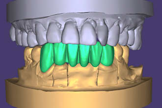 dental cad crown and implant design