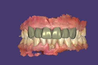 design dental crowns, bridges, veneers, and implants using exocad
