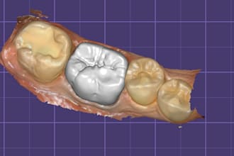 design dental crowns and bridges in exocad
