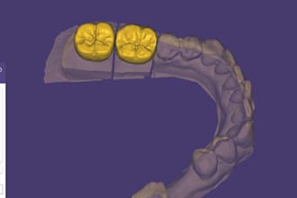 dental crown design exocad