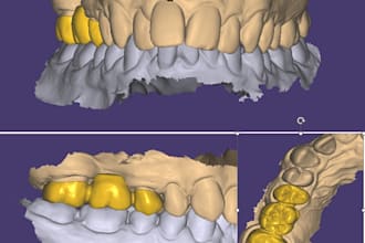 design exocad crowns and bridges for you accurately