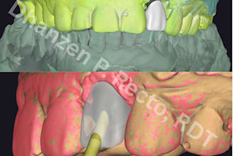 create exocad dental designs