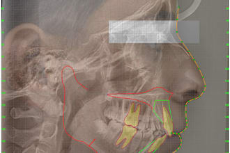 do cephalometric tracing and full orthodontic analysis