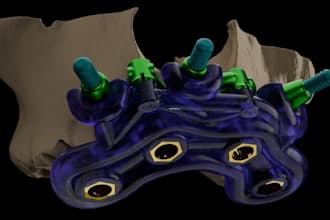 do surgical stackable guide
