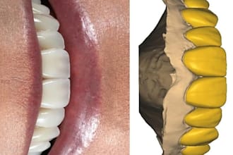 design dental crowns bridges prosthetics in 24 hours