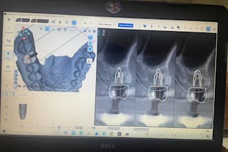make you surgical guide for dental implants