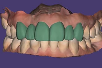do expert digital dental design on exocade for waxup