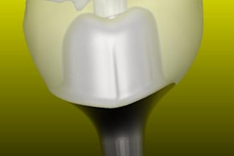 custom abutment on implants, screw retained