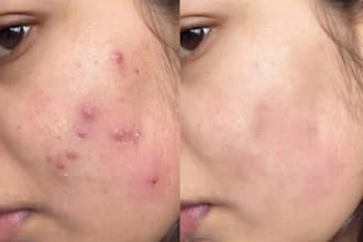 natural face editing and acne removal in 24 hours