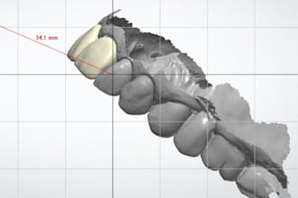 design dental restorations in 3shape