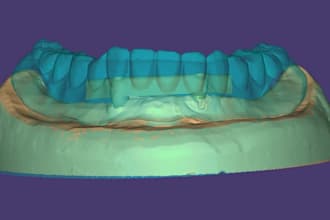 design implant bars and overdenture bars in exocad