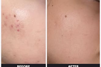 be your honest skincare advisor and build your anti acne routine