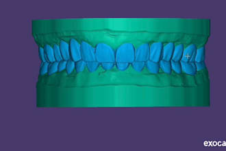 design dental crown and bridges using exocad