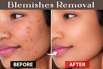 professionally remove acne, blemishes and skin imperfections naturally